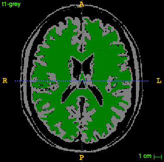 MRIImageSegmentation